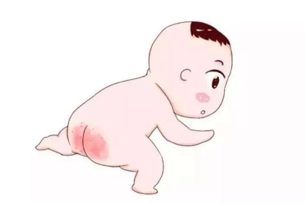 寶寶紅屁股怎么護理 寶寶紅屁股什么原因?qū)е?></a>
<p class=