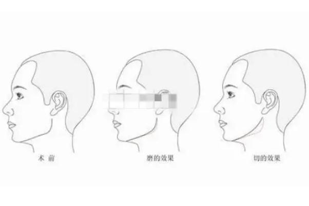 顴骨內(nèi)推的釘子需要取出嗎 顴骨內(nèi)推是幾級手術