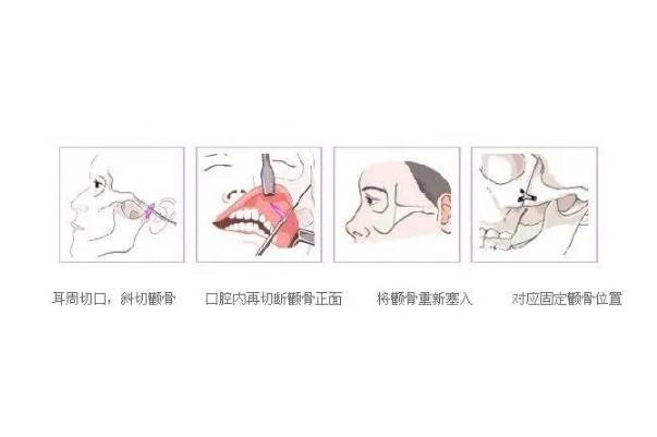 顴骨內(nèi)推的釘子需要取出嗎 顴骨內(nèi)推是幾級手術