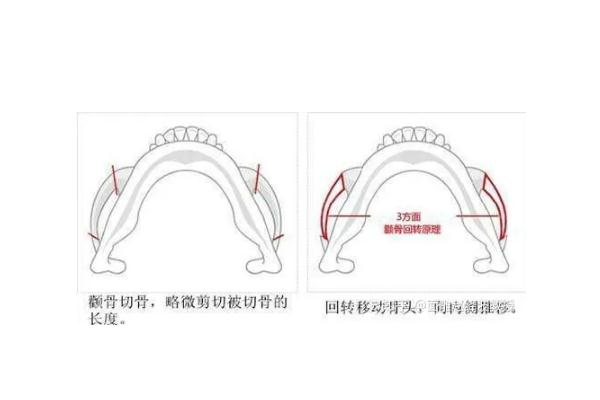 顴骨內(nèi)推的釘子需要取出嗎 顴骨內(nèi)推是幾級手術